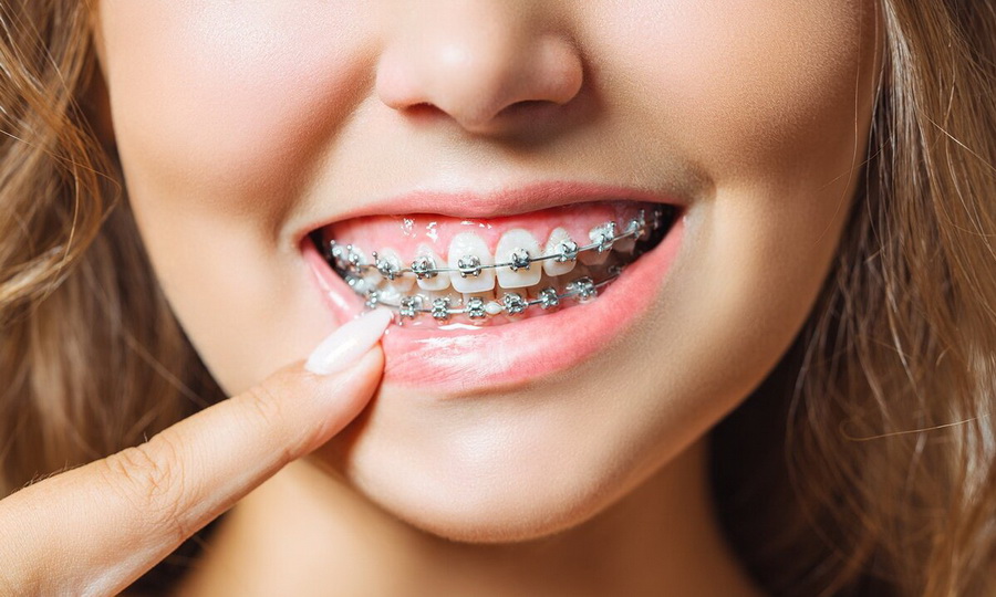 Современные брекеты становятся все более доступными и комфортными
